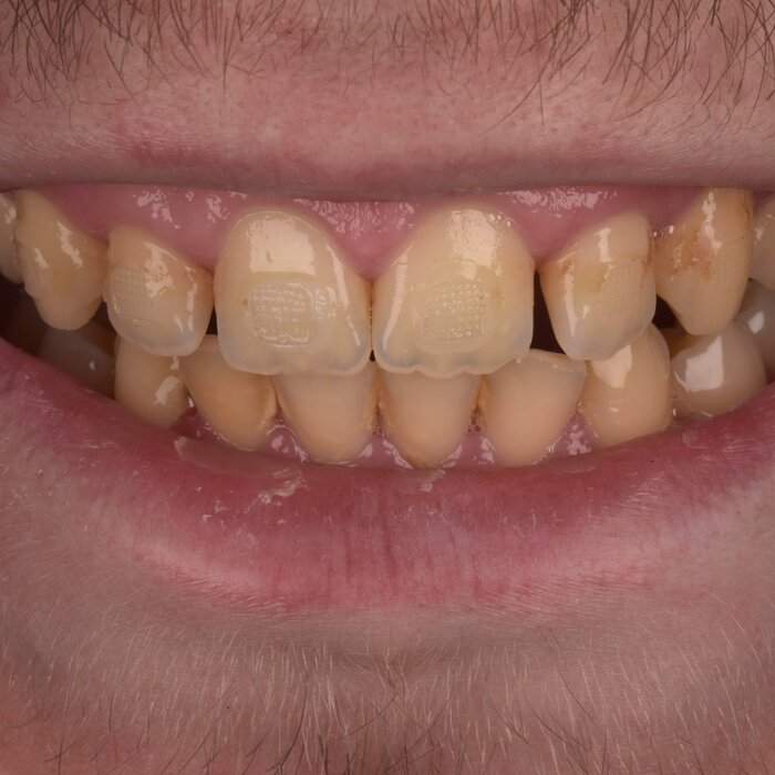 Before composite bonding at Seren Dental
