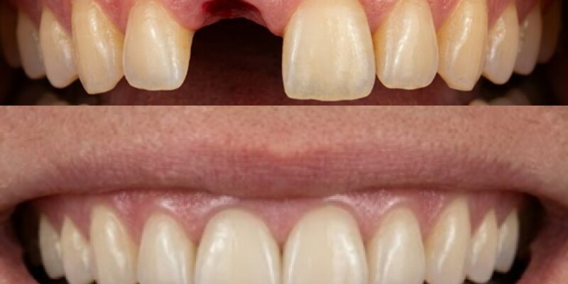 Your Dental Implant Journey at Seren Dental, Penylan