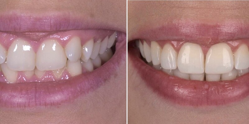 Your Invisalign Journey at Seren Dental, Penylan